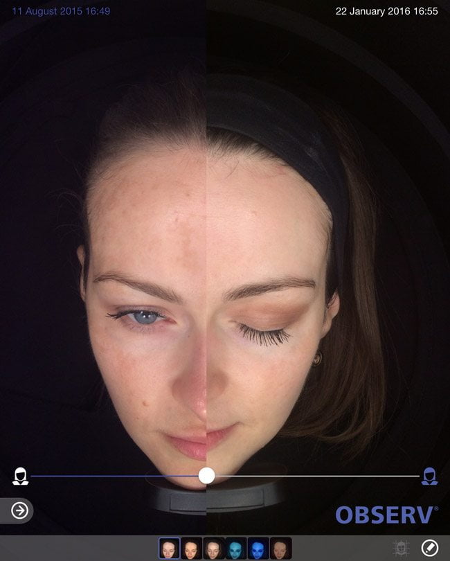 Skin-peel-pigmentation-before-and-after1-wr